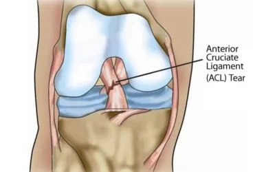 ACL Reconstruction Recovery Time
