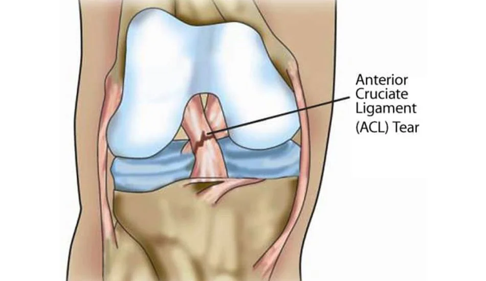ACL Reconstruction Recovery Time